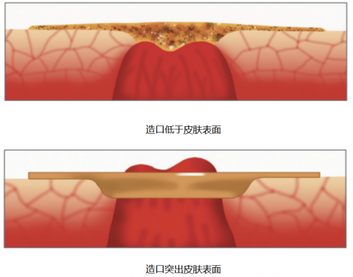 “造口护理：为什么要使用凸面底盘？