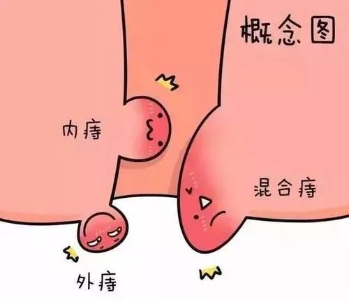 得了外痔肉球要怎么去除？